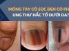 Sọc đen trên móng tay có phải dấu hiệu ung thư hắc tố da?