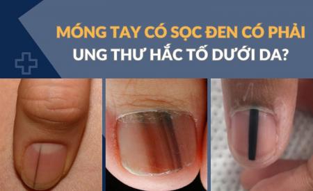 Sọc đen trên móng tay có phải dấu hiệu ung thư hắc tố da?